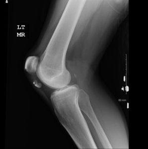 broken knee x ray