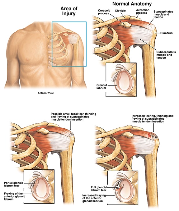 rotary shoulder injury